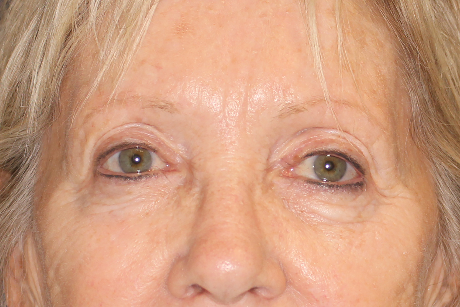 Brow Forehead Lift Before & After Image