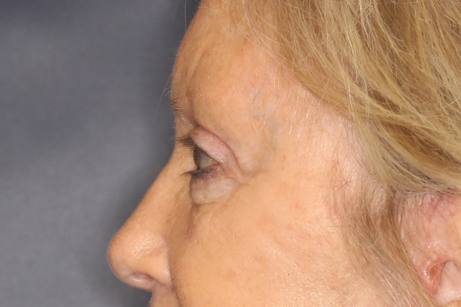 Brow Forehead Lift Before & After Image
