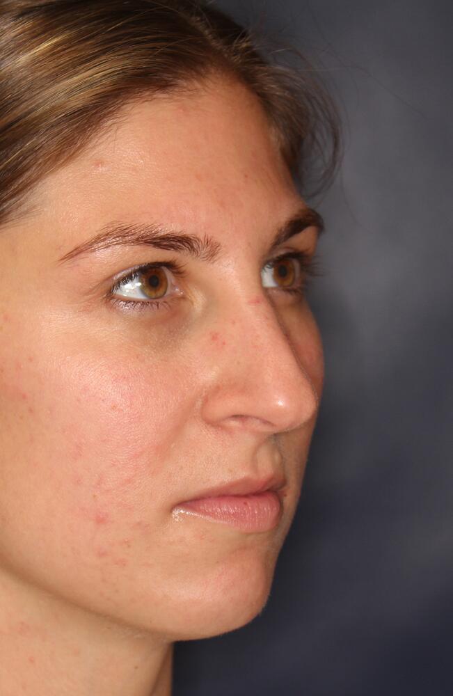 Nose Reshaping Before & After Image