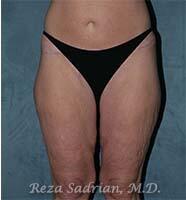 Surgery After Weight Loss Before & After Image