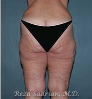 Surgery After Weight Loss Before & After Image