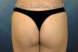 Brazilian Butt Lift Before & After Image