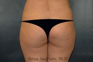 Brazilian Butt Lift Before & After Image