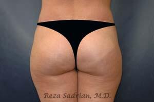 Brazilian Butt Lift Before & After Image