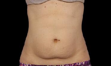 CoolSculpting Before & After Image