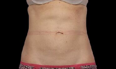 CoolSculpting Before & After Image