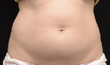 CoolSculpting Before & After Image