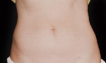 CoolSculpting Before & After Image