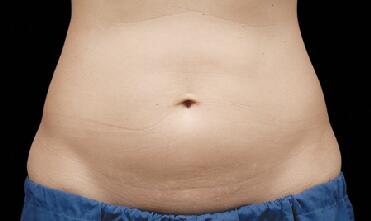 CoolSculpting Before & After Image