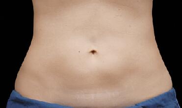 CoolSculpting Before & After Image