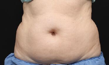 CoolSculpting Before & After Image