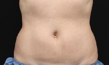 CoolSculpting Before & After Image