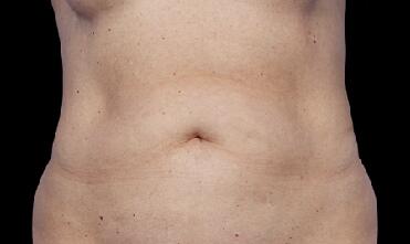 CoolSculpting Before & After Image