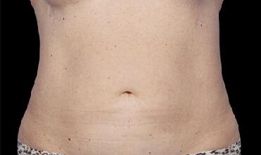 CoolSculpting Before & After Image