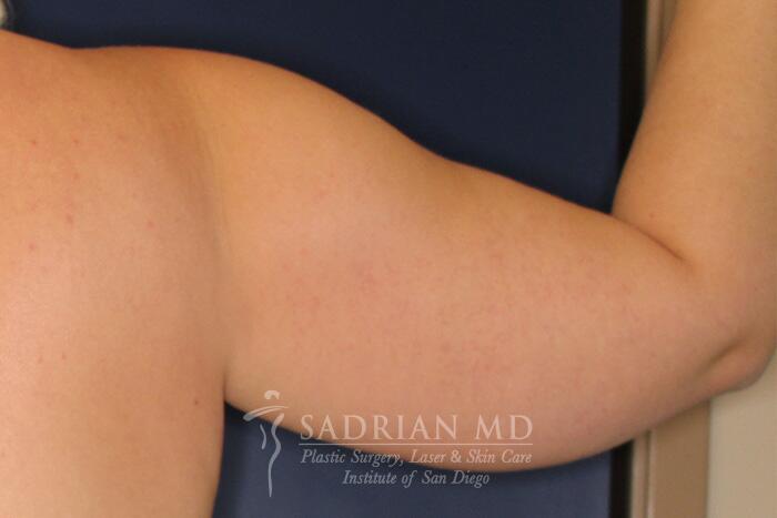 Liposuction Before & After Image