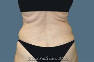 Liposuction Before & After Image