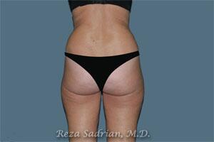 Liposuction Before & After Image