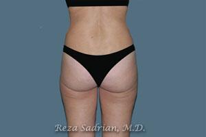 Liposuction Before & After Image