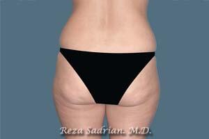 Liposuction Before & After Image