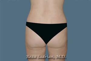 Liposuction Before & After Image