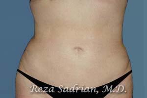 Liposuction Before & After Image