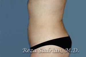 Liposuction Before & After Image