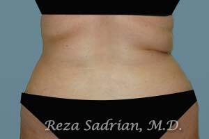 Liposuction Before & After Image