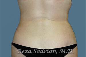 Liposuction Before & After Image