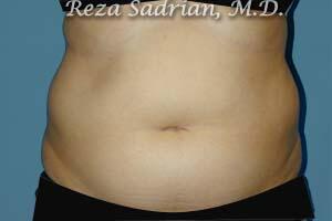 Liposuction Before & After Image