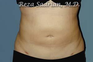 Liposuction Before & After Image