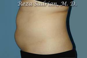 Liposuction Before & After Image