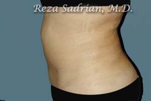 Liposuction Before & After Image