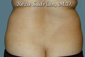 Liposuction Before & After Image