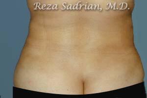 Liposuction Before & After Image