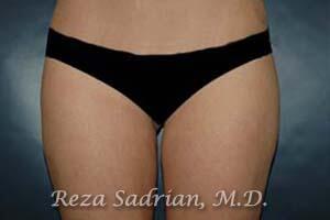 Liposuction Before & After Image