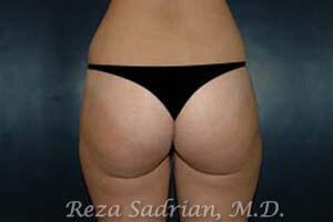 Liposuction Before & After Image