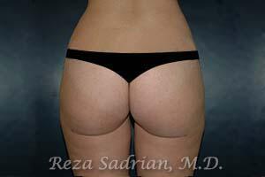 Liposuction Before & After Image