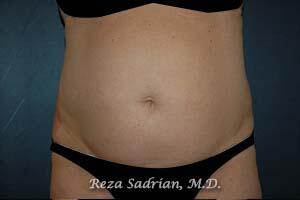 Liposuction Before & After Image