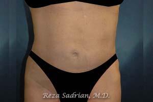 Liposuction Before & After Image