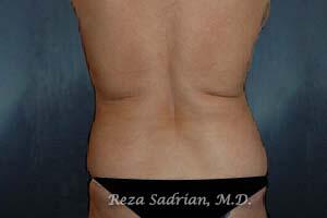 Liposuction Before & After Image