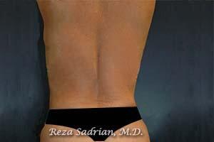 Liposuction Before & After Image