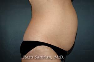 Liposuction Before & After Image