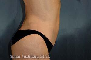 Liposuction Before & After Image