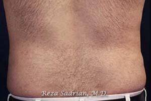 Liposuction Before & After Image