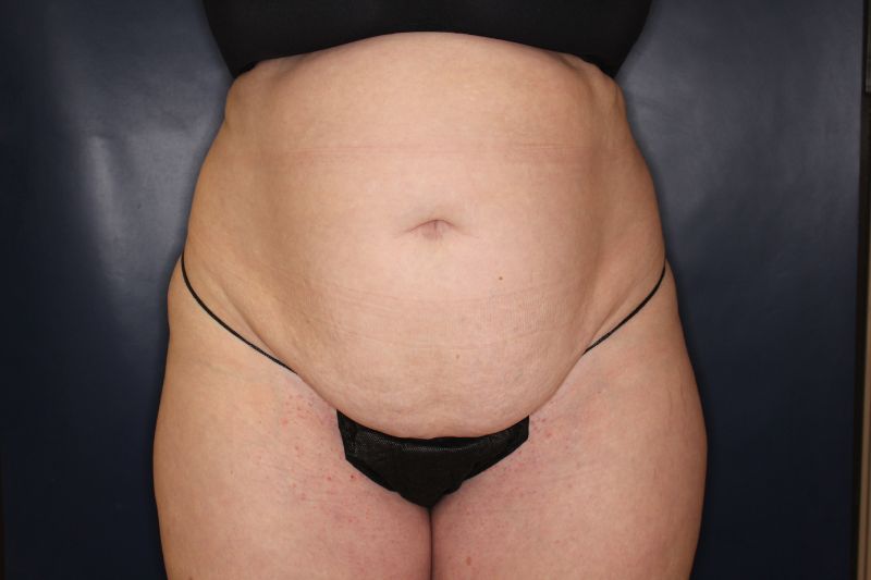 Liposuction Before & After Image