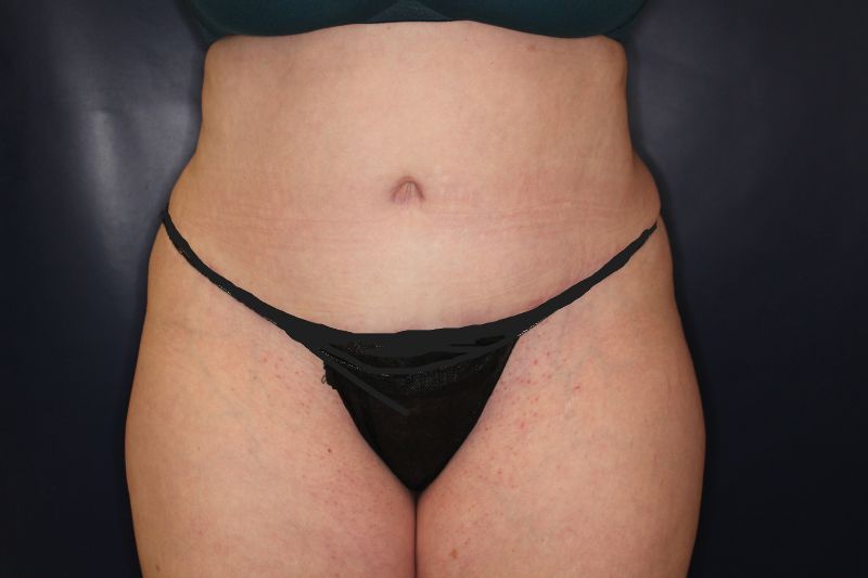 Liposuction Before & After Image