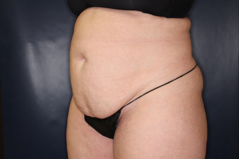 Liposuction Before & After Image