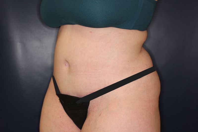 Liposuction Before & After Image