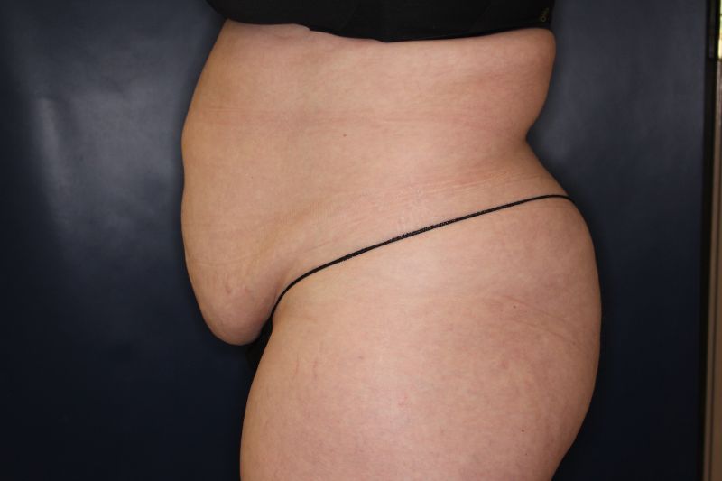 Liposuction Before & After Image