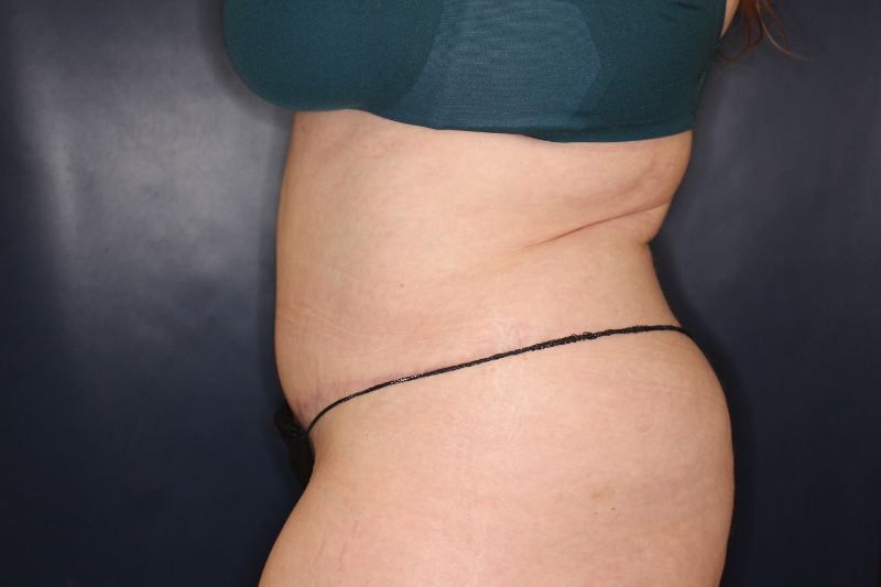 Liposuction Before & After Image